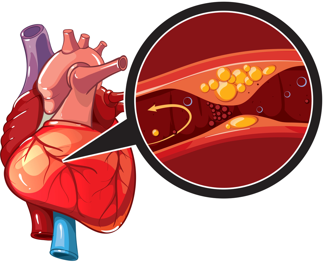 Coronary_disease_illustration.jpg
